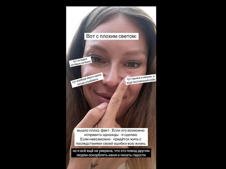 Неудачная пластическая операция: Рита Дакота столкнулась с критикой